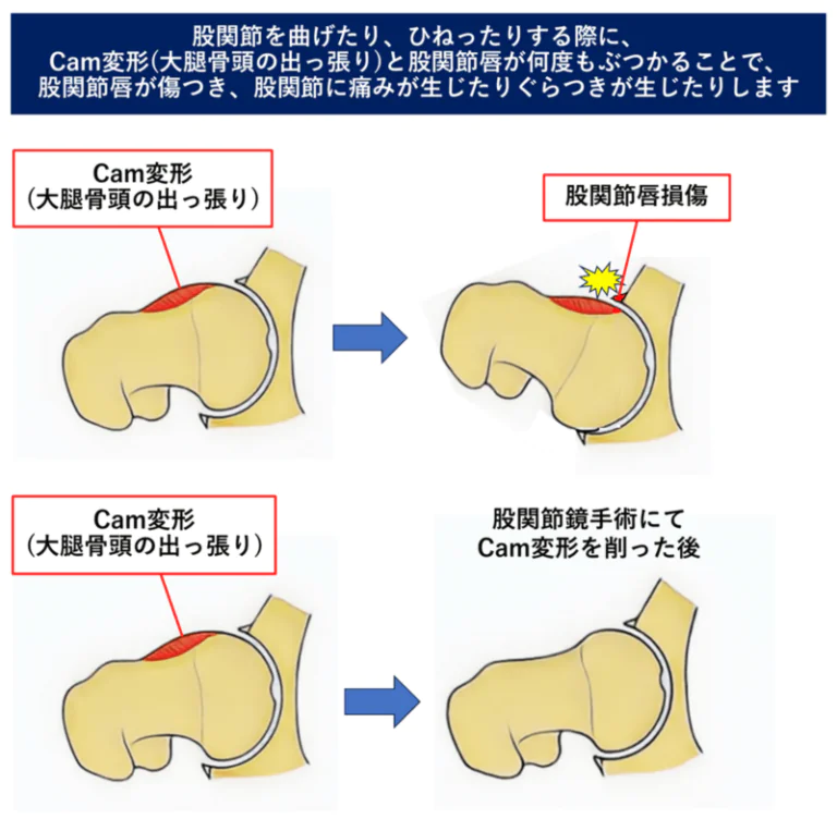 大腿骨寛骨臼インピンジメント(股関節インピンジメント、FAI)の股関節鏡手術 