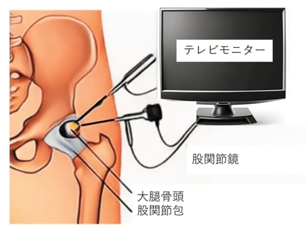 股関節鏡手術