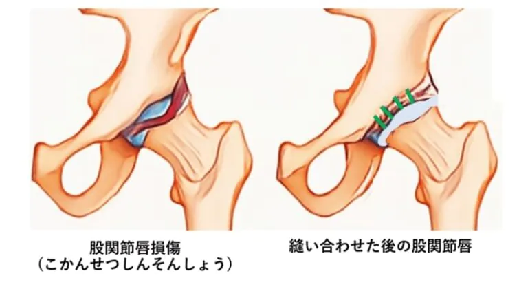 股関節鏡視下股関節唇形成術 