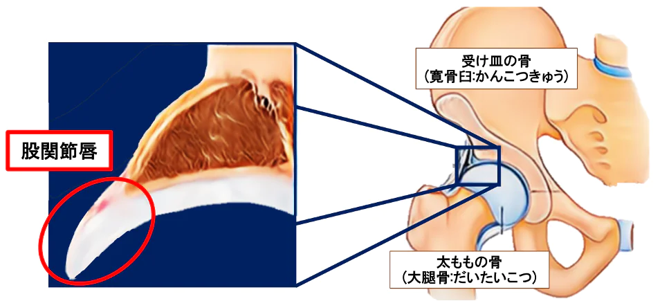 股関節唇損傷