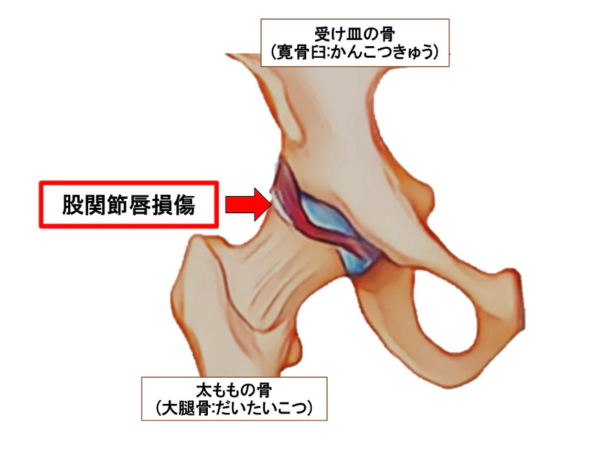 股関節唇損傷