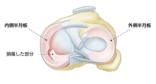 半月板損傷とは